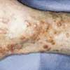 Erythema Elevatum Diutinum (EED)