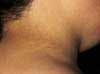 Benign Acanthosis Nigricans