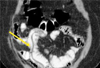 Helminthiasis Presenting as Microcytic Anemia