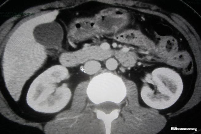 Rib Pain on Inhalation in a Young Woman 