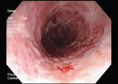 HSV esophagitis 