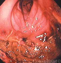 Acute Pulmonary Embolism