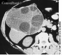 Echinococcosis of the Liver