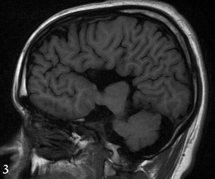 Talc Embolism: A Case of Extrapulmonary Complications