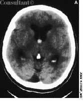 Colloid Cyst