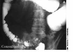 Colovesical Fistula