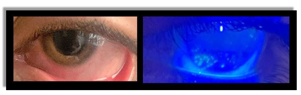 Image above: Fluoresceine enhanced exam with cobalt blue light on the slit lamp