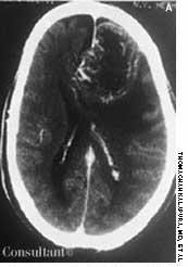 Glioblastoma Multiforme