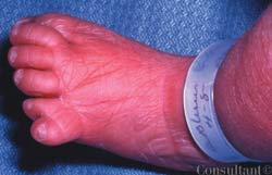 Polysyndactyly