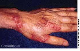 Tuberculoid Leprosy