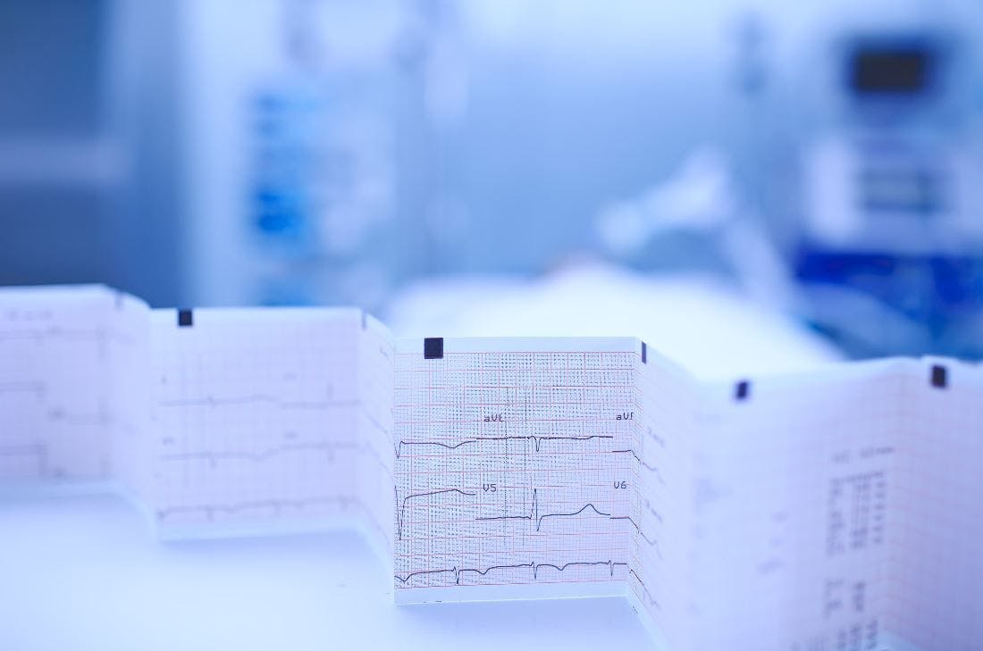 covid-19 and cardiac arrhythmia 