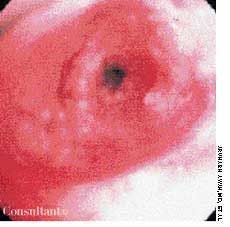 Endobronchial Sarcoidosis