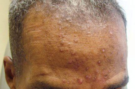 Folliculitis: Part II