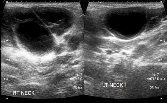 Bilateral Painless Swelling of the Neck in a 40-Year-Old Man 