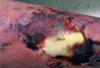 Elderly Man With a Non-Healing Leg Ulcer