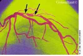 Restenosis After Percutaneous Transluminal Coronary Angioplasty