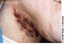 Pyoderma Gangrenosum: Three Cases