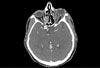 Orbital Pseudotumor Disguised as Orbital Cellulitis and Sinusitis