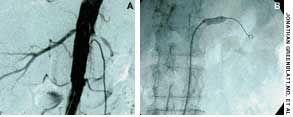 Renal Artery Stenosis Complicating Essential Hypertension