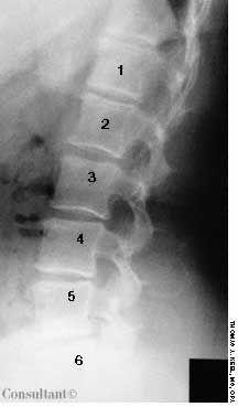 Sixth Lumbar Vertebra