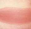 Erythema Chronicum Migrans in Lyme Disease