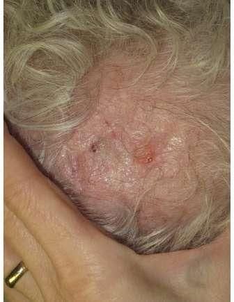 Crusty Scalp Lesion 