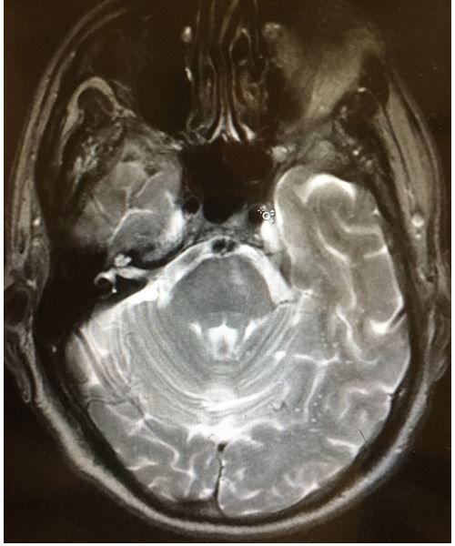 Weak in the Legs Plus Dysgeusia: Seen in the ED / image credit pontine stroke ©Brady Pregerson, MD 