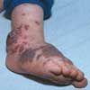 Klippel-Trenaunay-Weber Syndrome