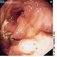 Suture Granuloma