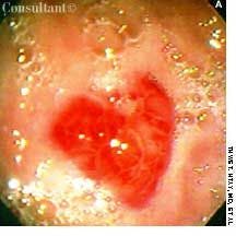 Gastric Kaposi's Sarcoma