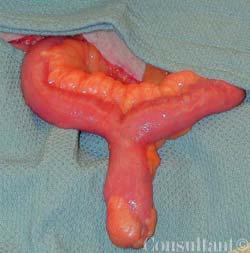 Meckel Diverticulum