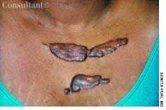 Keloid