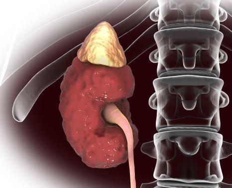 Elevated Phosphorous in CKD: How to Avoid Vascular Calcification