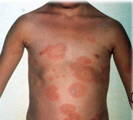 Rheumatic Fever Quiz: 8 Keys to Diagnosis