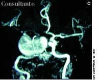 Giant Cavernous Sinus Aneurysm