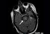 A Middle-Aged Alcoholic Woman With Hyponatremia