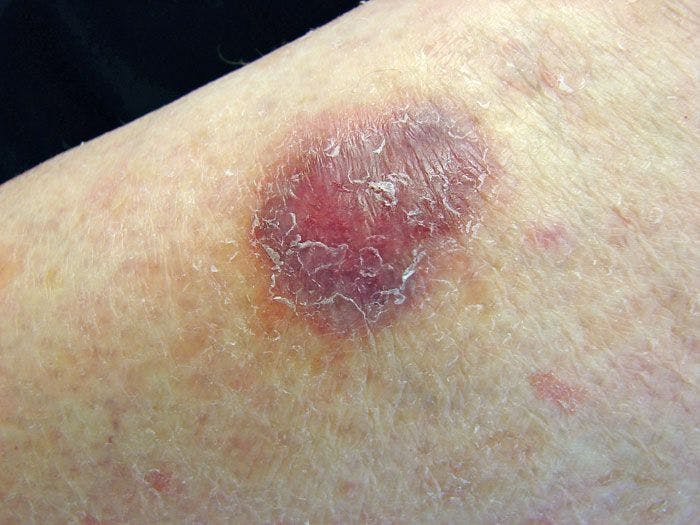 Hard Purple Nodules: Your Dx?