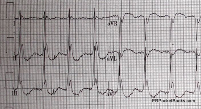 Hypothermia in an Elderly Man 