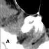 Nasal Septal Abscess