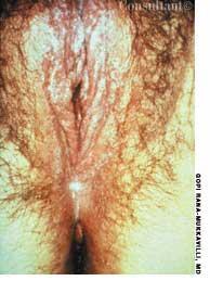 Vaginal Candidiasis in a 23-Year-Old Woman