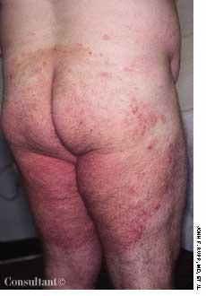 Tinea Corporis: An Overview