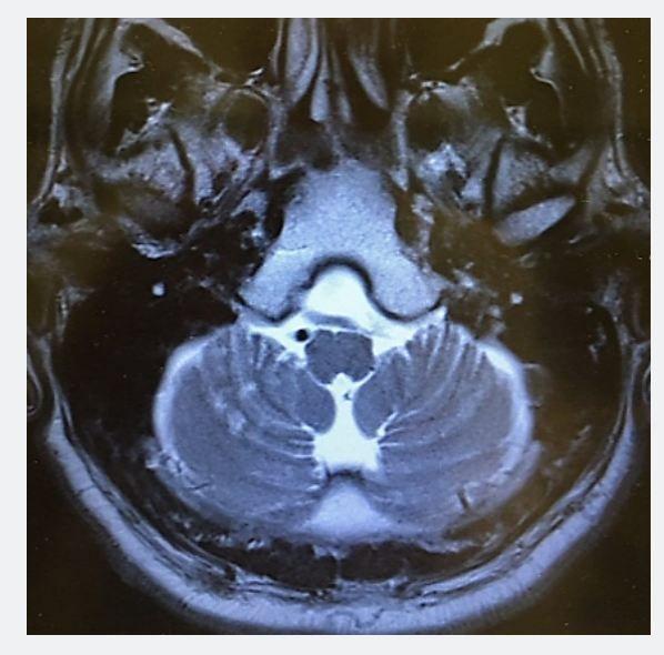 Tinnitus and Blurry Vision in a Middle-aged Man 