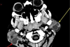 Bilateral Parotid Swellings in an HIV-Positive Patient