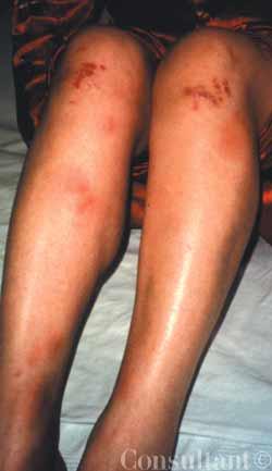 Erythema Nodosum