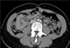 Bilateral Ovarian Vein Thrombosis After C-Section Delivery