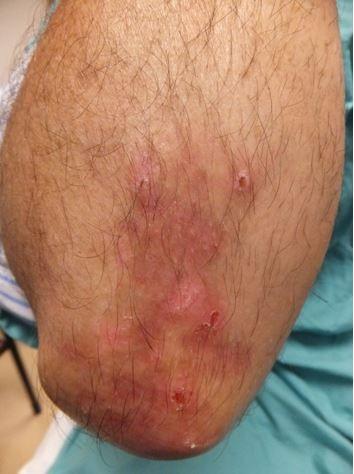 Dermatitis Herpetiformis