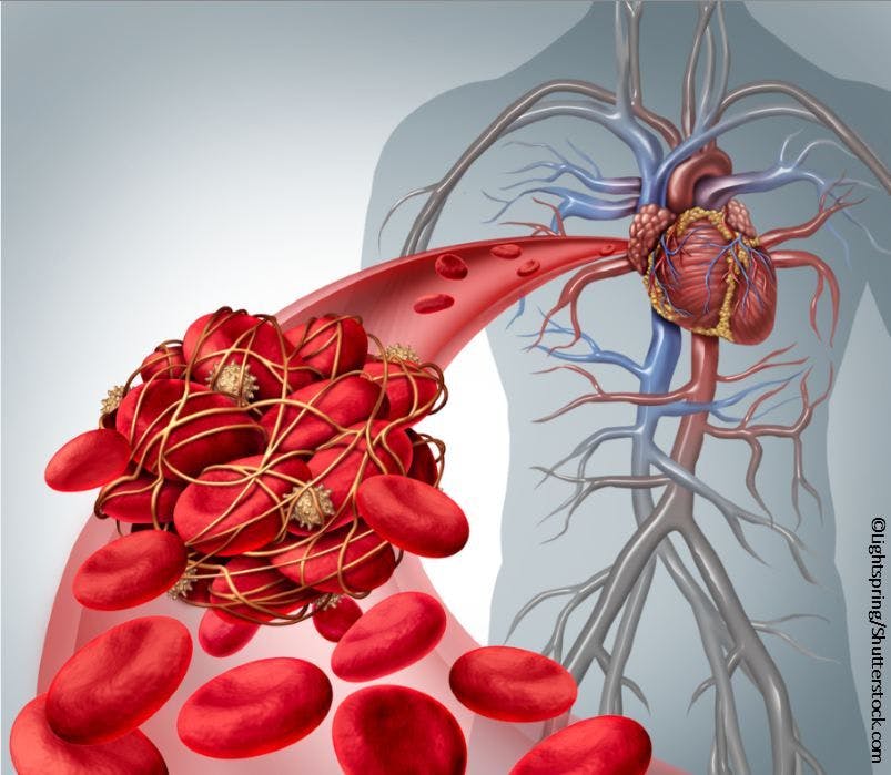 Burden of Atrial Fibrillation in Patients with Ischemic Stroke is Substantial According to New Study