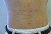 Striae (Stretch Marks)