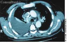 Superior Vena Cava Thrombosis