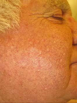 Sebaceous Hyperplasia